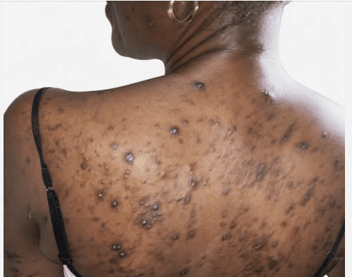Understanding Pruritic Papular Eruption (PPE): A Common Skin Condition Associated with HIV