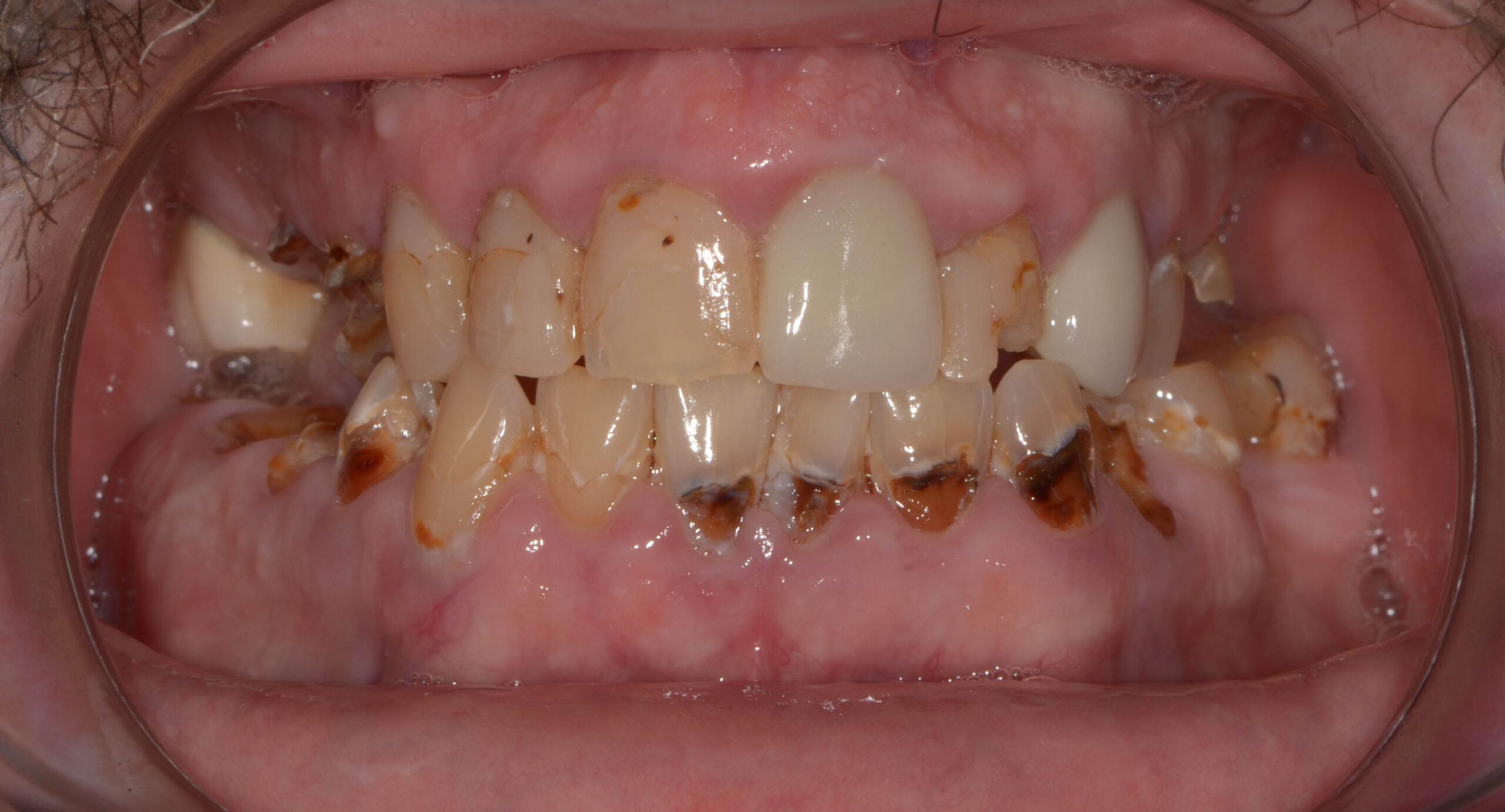 Rising Tooth Decay Among School Children Alarms Health Experts in Ghana