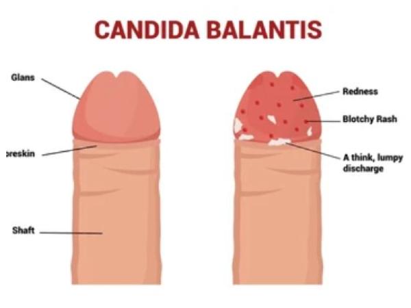 Candida Balanitis: What Men Need to Know About Causes, Symptoms, and Prevention